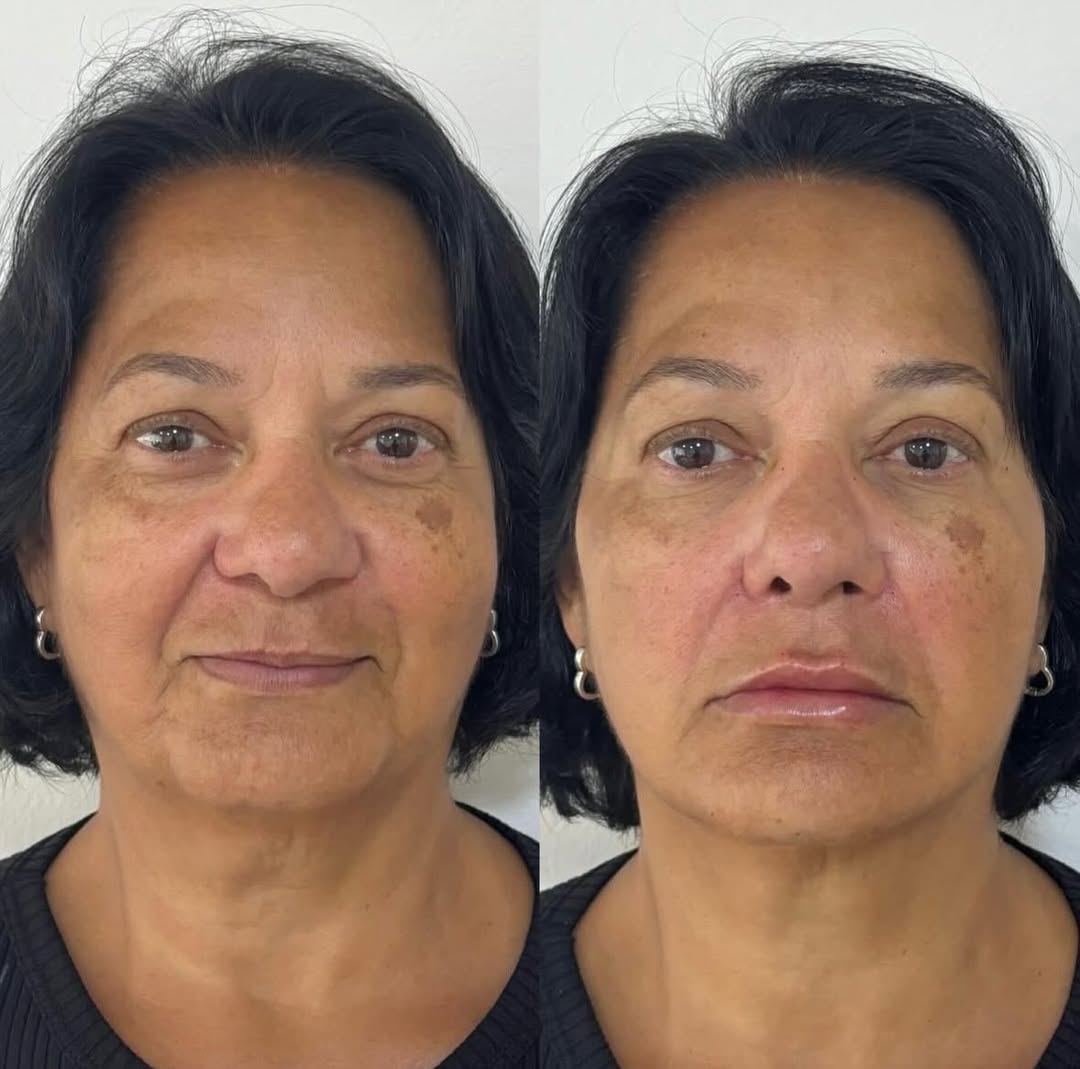 Harmonização e Lipo de Papada — antes e depois